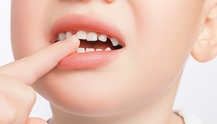 Closeup,Of,The,Boy,Touches,A,Crooked,Milk,Tooth,And