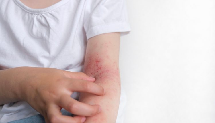 The,Child,Scratches,Atopic,Skin.,Dermatitis,,Diathesis,,Allergy,On,The